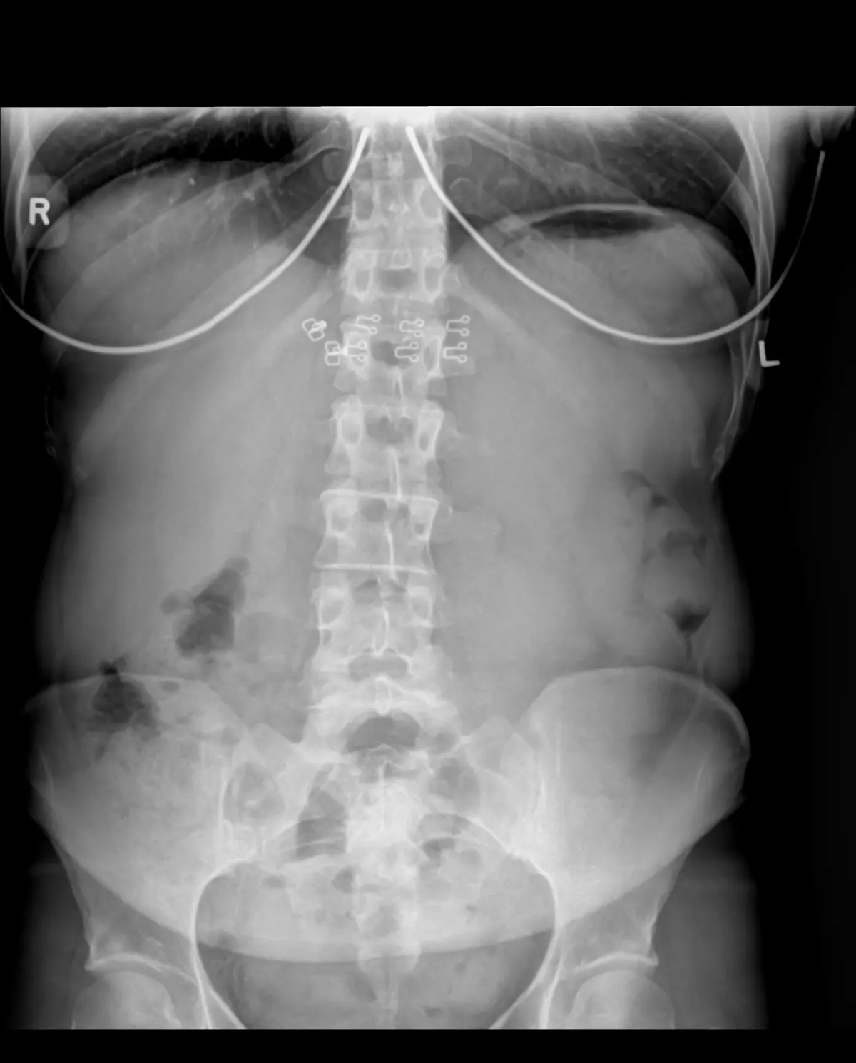 Scoliose de l'Enfant et de l'Adolescent : Le Rôle de la Kinésithérapie